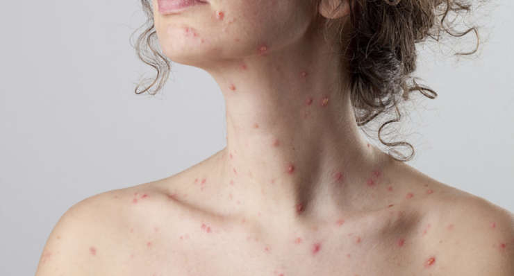 Herpes Zooster
