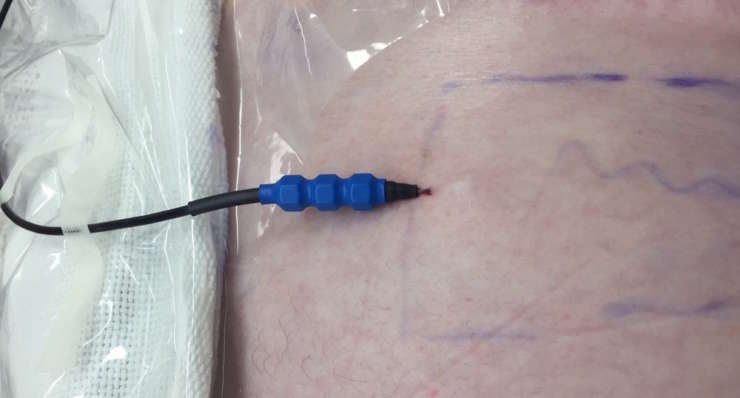 PENS e Radiofrequenza Pulsata