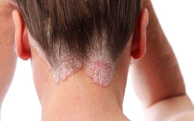 Psoriasi